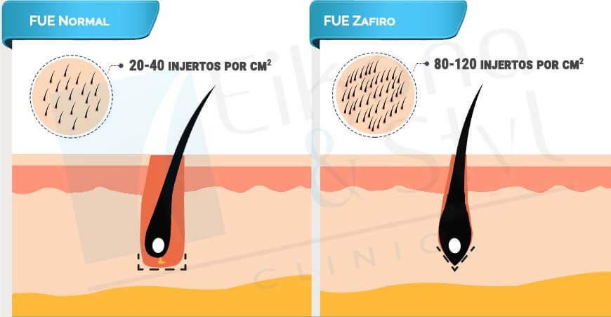 FUE Zafiro: 6 ventajas de este microinjerto de cabello de vanguardia